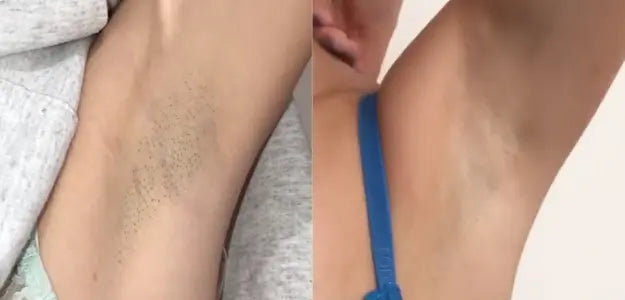 Pocket IPL Hair Removal Device