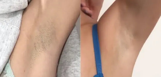 Pocket IPL Hair Removal Device