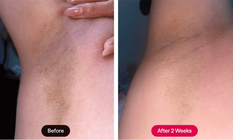 Pocket IPL Hair Removal Device